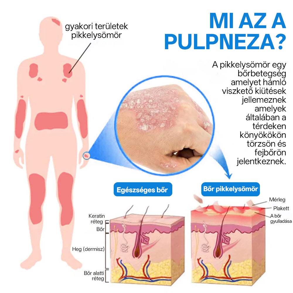 ✅ Hivatalos bolt: Zvoevo® Magnéziumos gyógynövényes spray pikkelysömörre ⚕️ MHRA tanúsítvánnyal (enyhíti a pikkelysömört, ekcémát, kezeli pattanásokat, szemölcsöket, javítja bakteriális fertőzéseket, csökkenti ízületi és neuropátiás fájdalmakat)-1