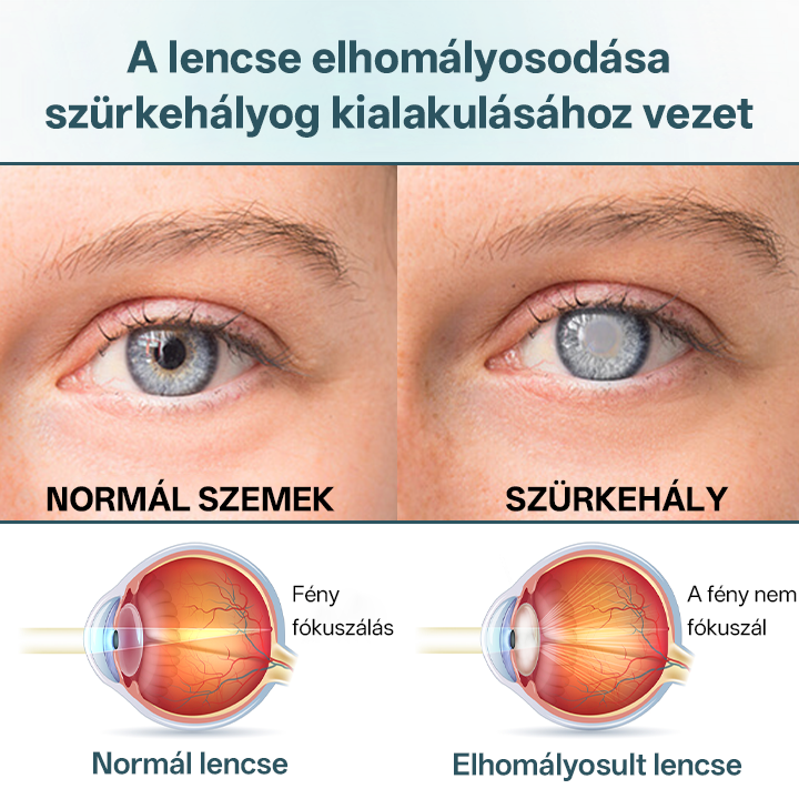 ✅Timilk® OptiFusion Nano szemcsepp szérum⭐