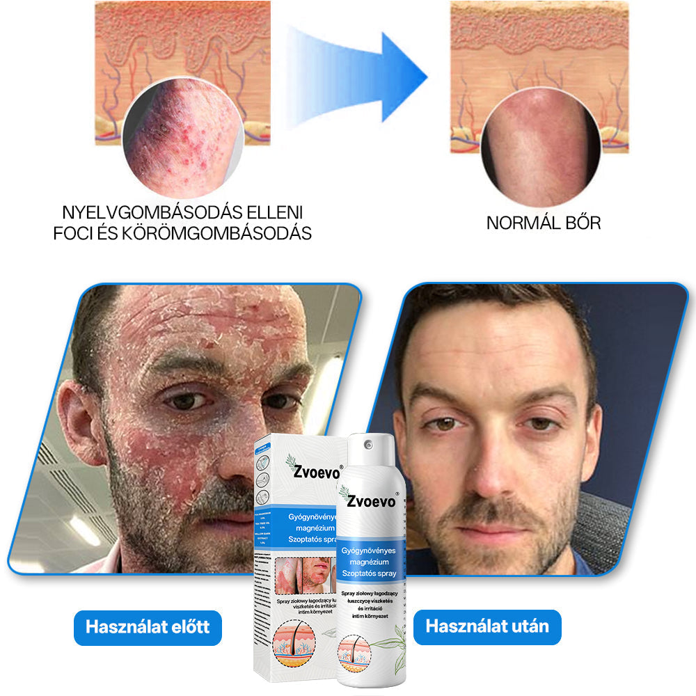 ✅ Hivatalos bolt: Zvoevo® Magnéziumos gyógynövényes spray pikkelysömörre ⚕️ MHRA tanúsítvánnyal (enyhíti a pikkelysömört, ekcémát, kezeli pattanásokat, szemölcsöket, javítja bakteriális fertőzéseket, csökkenti ízületi és neuropátiás fájdalmakat)-1