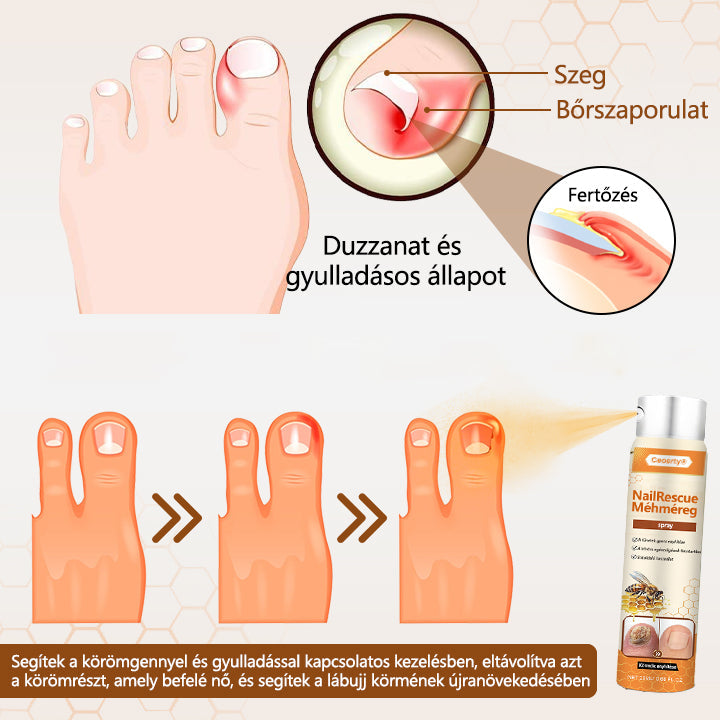 2025🎁 Korlátozott idejű akció 70% kedvezménnyel ️️⏳ Ceoerty® körömgomba spray méhméreggel 💥 2 hét alatt megoldja az összes körömproblémát