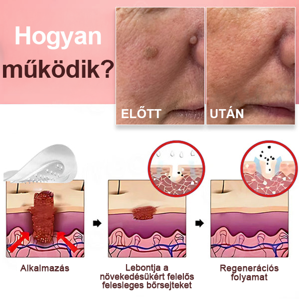KUBOZN® Nano-mikrotűs bőrcímke-eltávolító tapaszok 🔸