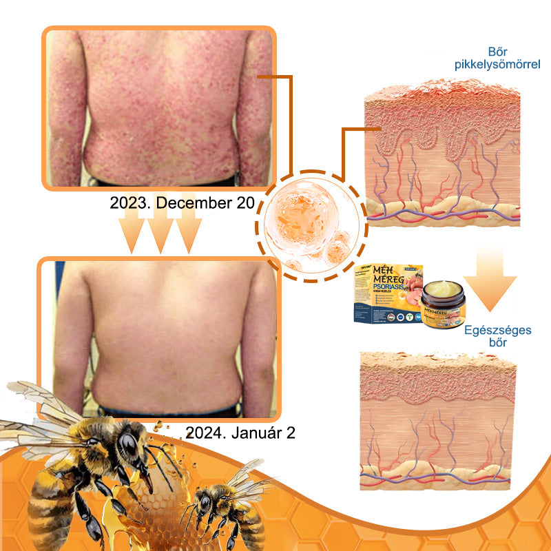 Ourlyard™ Méhméreg Haladó Psoriasis Kezelő Kenőcs (👨Orvos által ajánlott)