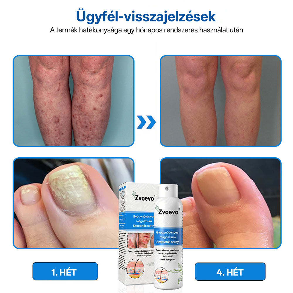 ✅ Hivatalos bolt: Zvoevo® Magnéziumos gyógynövényes spray pikkelysömörre ⚕️ MHRA tanúsítvánnyal (enyhíti a pikkelysömört, ekcémát, kezeli pattanásokat, szemölcsöket, javítja bakteriális fertőzéseket, csökkenti ízületi és neuropátiás fájdalmakat)-1