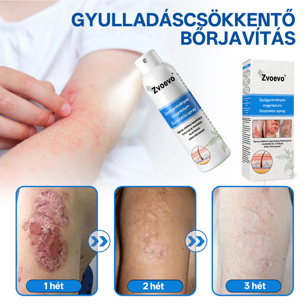 ✅ Hivatalos bolt: Zvoevo® Magnéziumos gyógynövényes spray pikkelysömörre ⚕️ MHRA tanúsítvánnyal (enyhíti a pikkelysömört, ekcémát, kezeli pattanásokat, szemölcsöket, javítja bakteriális fertőzéseket, csökkenti ízületi és neuropátiás fájdalmakat)-1