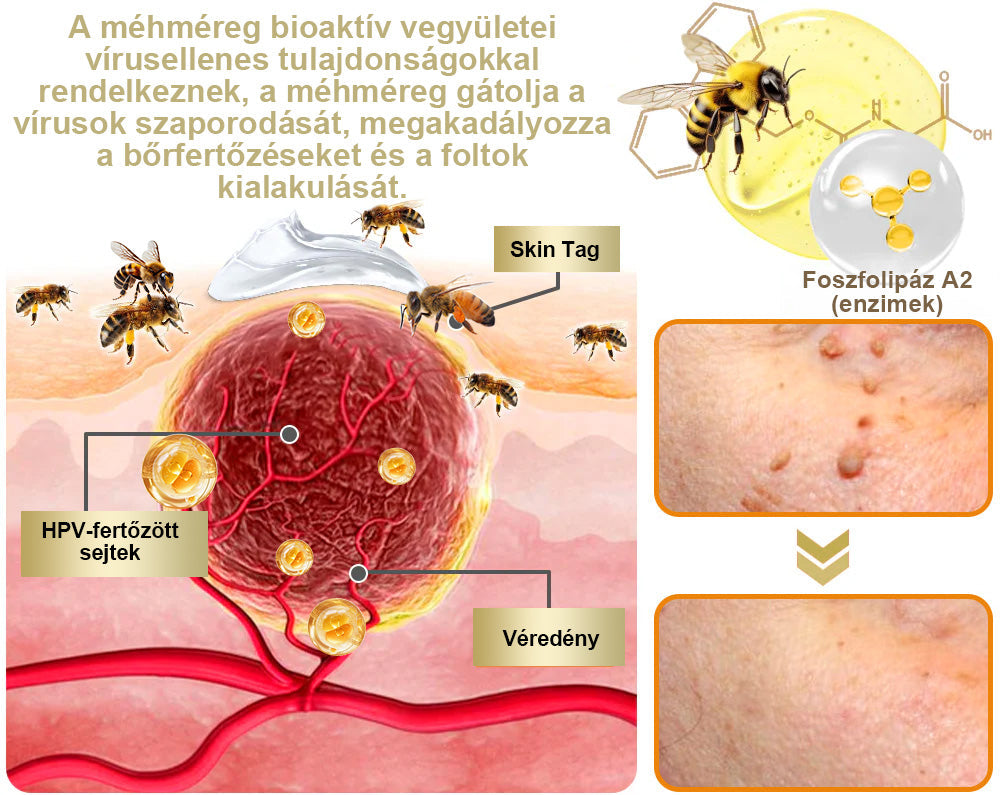 [Utánvétes fizetés] Méhméreg krém szemölcsök és anyajegyek eltávolítására (👨‍⚕ Bőrgyógyászok ajánlásával) 🐝 Utolsó nap – 70% kedvezmény! 🔥