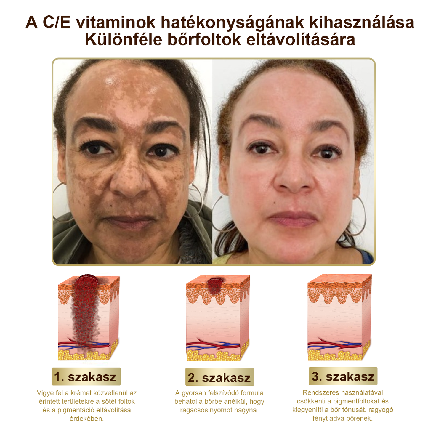 [Utánvétes fizetés] Méhméreg krém szemölcsök és anyajegyek eltávolítására (👨‍⚕ Bőrgyógyászok ajánlásával) 🐝 Utolsó nap – 70% kedvezmény! 🔥