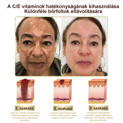 [Utánvétes fizetés] Méhméreg krém szemölcsök és anyajegyek eltávolítására (👨‍⚕ Bőrgyógyászok ajánlásával) 🐝 Utolsó nap – 70% kedvezmény! 🔥