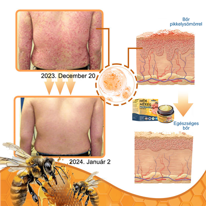 Ourlyard™ Méhméreg Haladó Psoriasis Kezelő Kenőcs (👨Orvos által ajánlott)