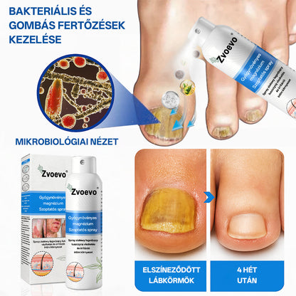 ✅ Hivatalos bolt: Zvoevo® Magnéziumos gyógynövényes spray pikkelysömörre ⚕️ MHRA tanúsítvánnyal (enyhíti a pikkelysömört, ekcémát, kezeli pattanásokat, szemölcsöket, javítja bakteriális fertőzéseket, csökkenti ízületi és neuropátiás fájdalmakat)