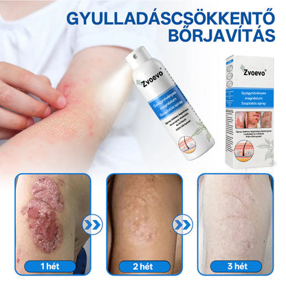 ✅ Hivatalos bolt: Zvoevo® Magnéziumos gyógynövényes spray pikkelysömörre ⚕️ MHRA tanúsítvánnyal (enyhíti a pikkelysömört, ekcémát, kezeli pattanásokat, szemölcsöket, javítja bakteriális fertőzéseket, csökkenti ízületi és neuropátiás fájdalmakat)