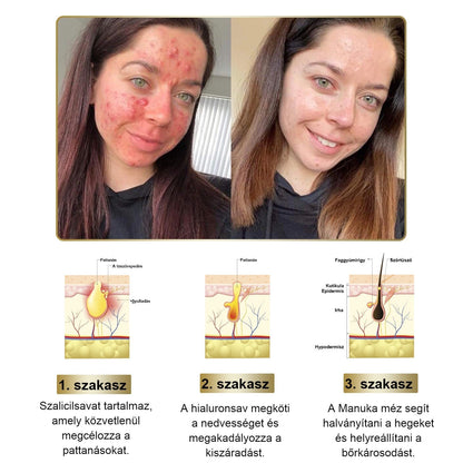 [Utánvétes fizetés] Méhméreg krém szemölcsök és anyajegyek eltávolítására (👨‍⚕ Bőrgyógyászok ajánlásával) 🐝 Utolsó nap – 70% kedvezmény! 🔥